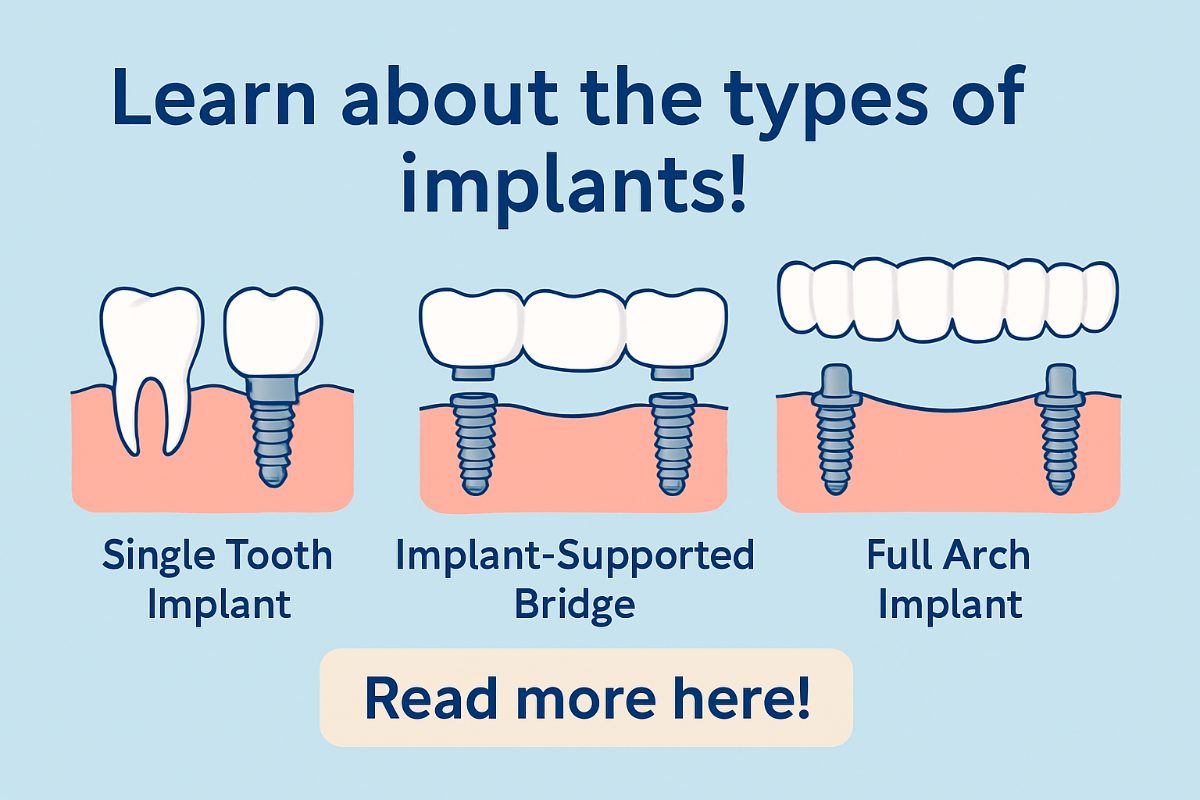 A comparison chart illustrating the different types of dental implants, including endosteal, subperiosteal, and zygomatic, with brief descriptions and ideal use cases for each. No text on image.